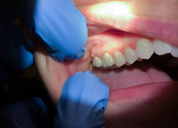 Best Emergency Denture Repair in Stamford, CT